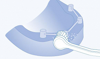 Гигиенический уход за имплантатами