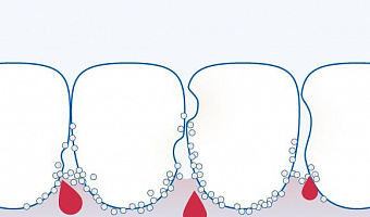 Кровоточивость десен – это первый признак воспаления